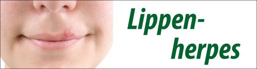 Lippenherpes